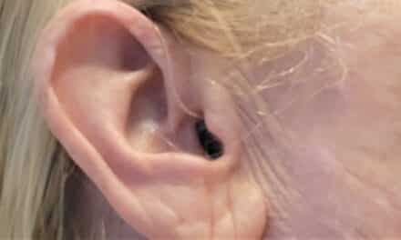Audífonos invisibles, lo que debes saber